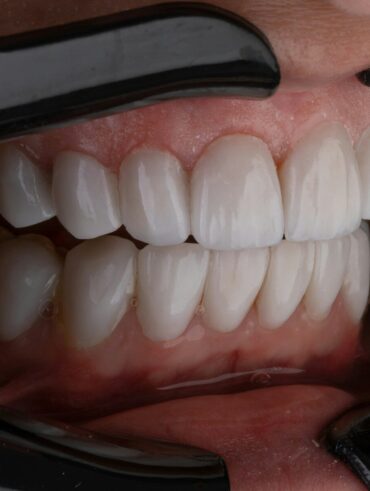 a person's mouth with teeth